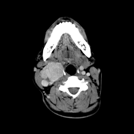 File:Carotid body tumor (Radiopaedia 27890-28124 A 16).jpg