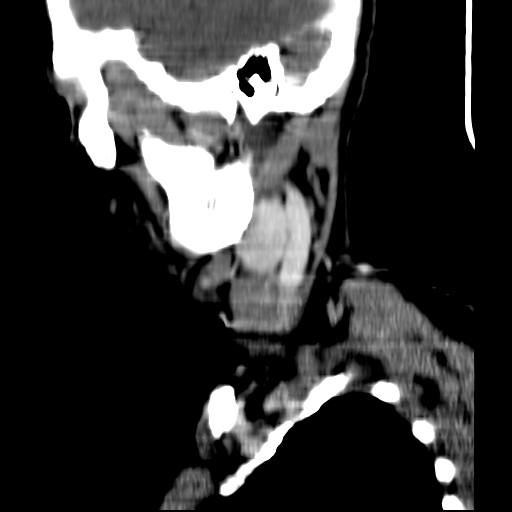 File:Carotid body tumor (Radiopaedia 27890-28124 C 22).jpg