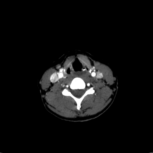 File:Carotid body tumor (Radiopaedia 39845-42300 B 15).jpg