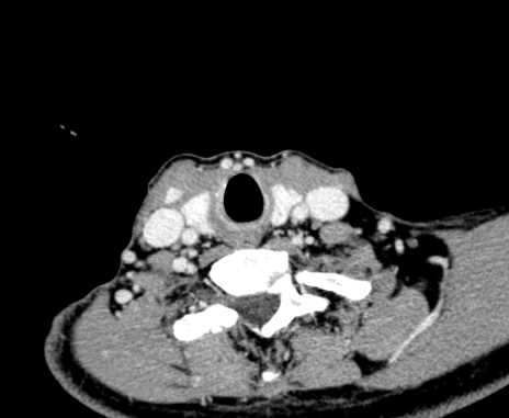 Carotid body tumor (Radiopaedia 61750-69757 Axial Post contrast 94).jpg