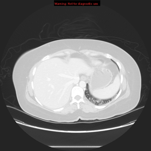 File:Carotid body tumor with lung metastases (Radiopaedia 9301-48390 Axial lung window 58).jpg