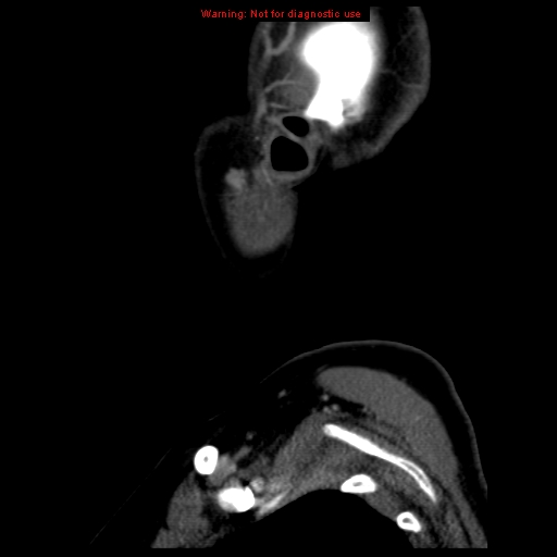 Carotid body tumor with lung metastases (Radiopaedia 9301-9986 Sagittal C+ delayed 52).jpg