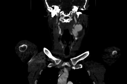 File:Carotid bulb pseudoaneurysm (Radiopaedia 57670-64616 D 19).jpg