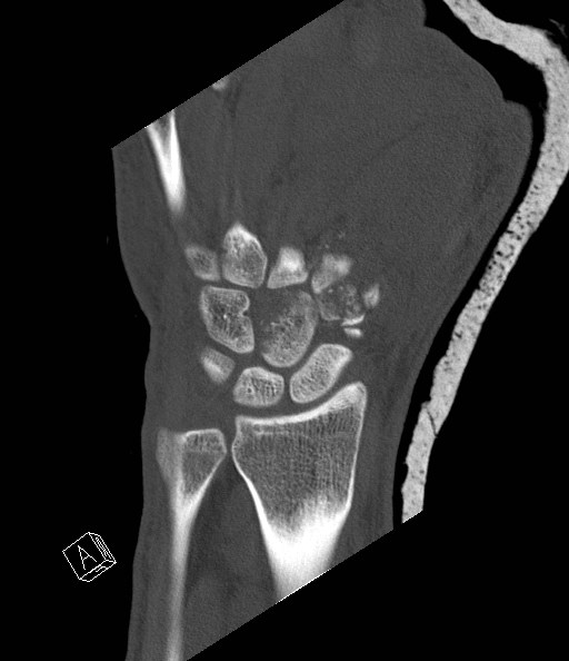 File:Carpal fractures (smart watch impaction) (Radiopaedia 55844-62430 Coronal bone window 10).jpg