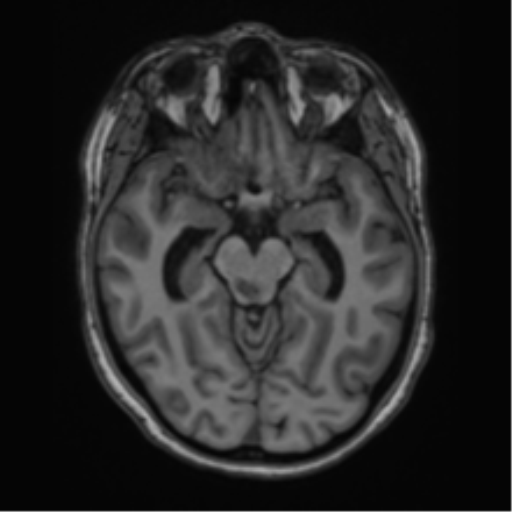 Cavernoma with bleed - midbrain (Radiopaedia 54546-60774 Axial T1 14).png