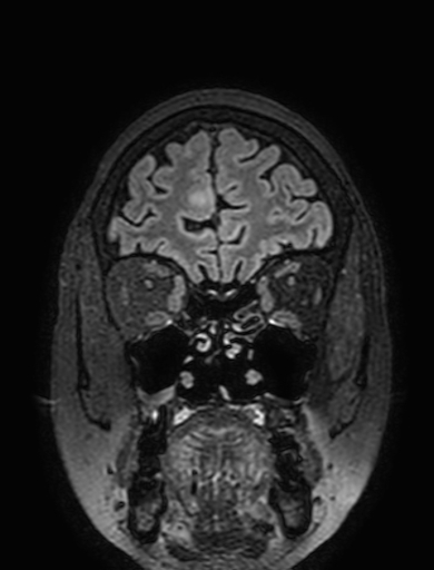 Cavernous hemangioma of the cerebellar falx (Radiopaedia 73025-83724 Coronal FLAIR 56).jpg