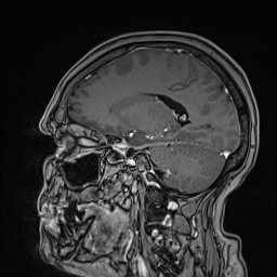 Cavernous sinus meningioma (Radiopaedia 63682-72367 Sagittal T1 C+ 107).jpg