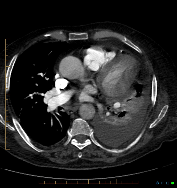Cavitating pulmonary infarction (Radiopaedia 54634-60849 Axial C+ CTPA 44).jpg