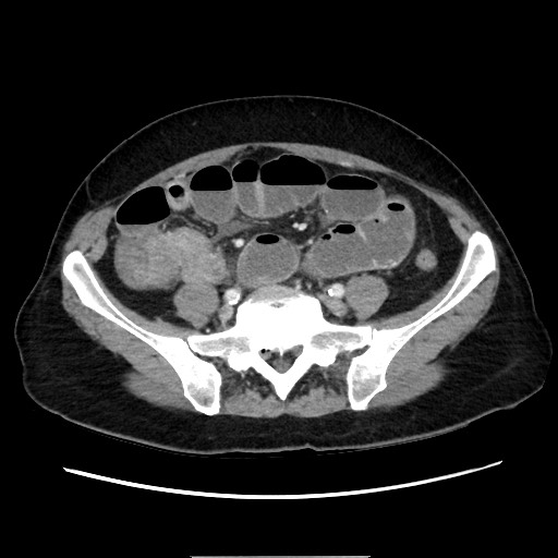 File:Cecal adenocarcinoma (Radiopaedia 75909-87331 A 63).jpg