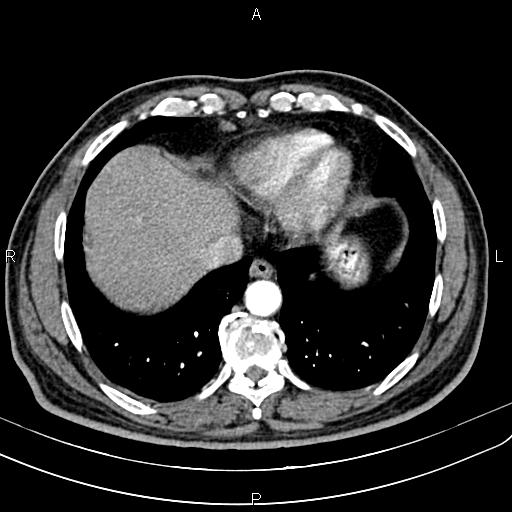 File:Cecal cancer with appendiceal mucocele (Radiopaedia 91080-108651 A 51).jpg