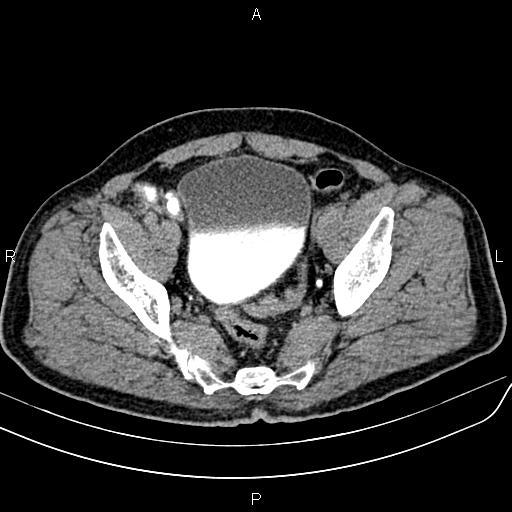 File:Cecal cancer with appendiceal mucocele (Radiopaedia 91080-108651 Axial C+ delayed 69).jpg