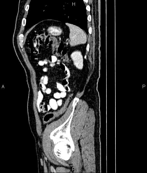 Cecal cancer with appendiceal mucocele (Radiopaedia 91080-108651 E 80).jpg