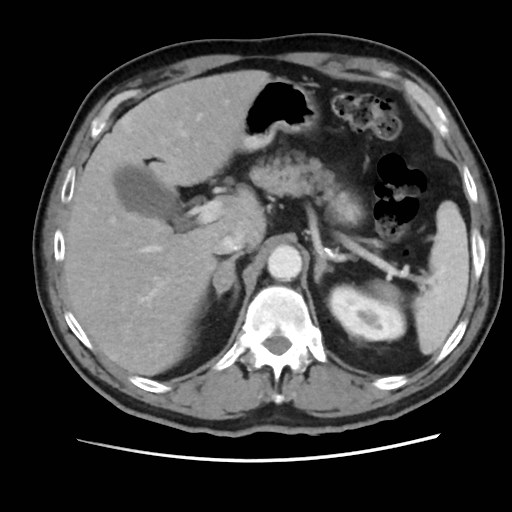 Cecal mass causing appendicitis (Radiopaedia 59207-66531 A 24).jpg