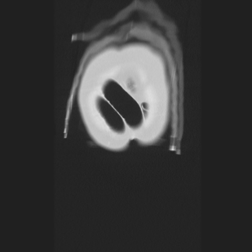 Cecal volvulus (Radiopaedia 75378-86620 Coronal lung window 12).jpg