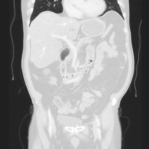 Cecal volvulus (Radiopaedia 75378-86620 Coronal lung window 67).jpg