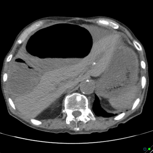 File:Cecal volvulus - atypical (Radiopaedia 21637-21588 non-contrast 16).jpg