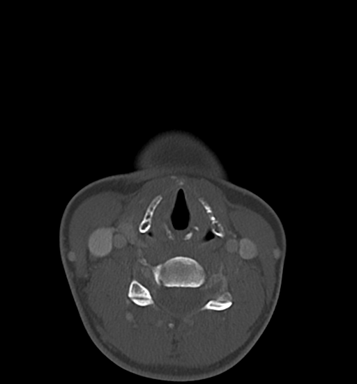 File:Cemento-ossifying fibroma (Radiopaedia 46243-50643 Axial bone window 55).png