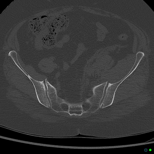 File:Central fracture-dislocation of the acetabulum (Radiopaedia 36578-38150 Axial bone window 20).jpg