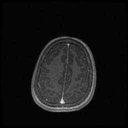 Central neurocytoma (Radiopaedia 30220-30842 Axial T1 C+ 123).jpg