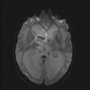 File:Central neurocytoma (Radiopaedia 56690-63469 Axial DWI 28).jpg