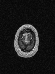 Central neurocytoma (Radiopaedia 56690-63469 Axial T1 C+ 154).jpg