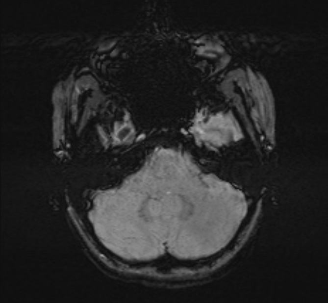 Central neurocytoma (Radiopaedia 70263-80336 Axial SWI 10).jpg