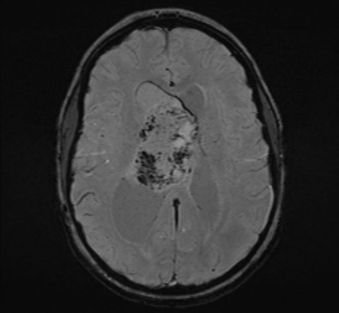 Central neurocytoma (Radiopaedia 70263-80336 Axial SWI 34).jpg