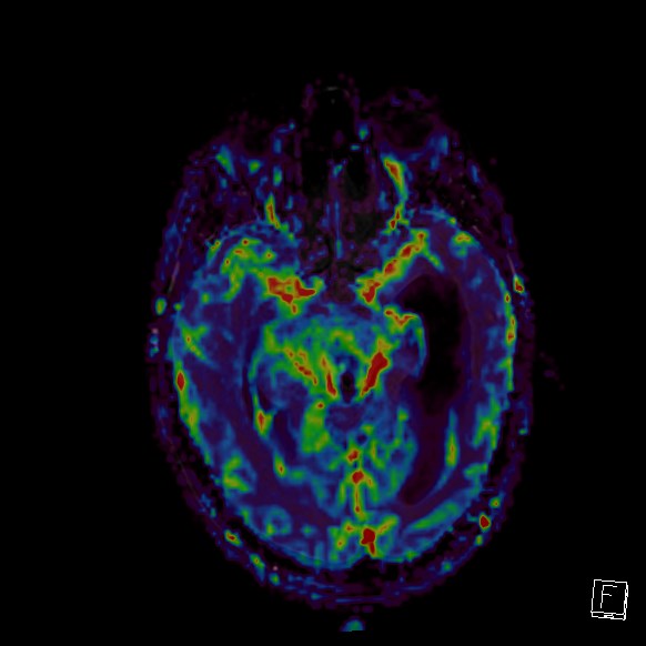 Central neurocytoma (Radiopaedia 84497-99872 Axial Perfusion 194).jpg
