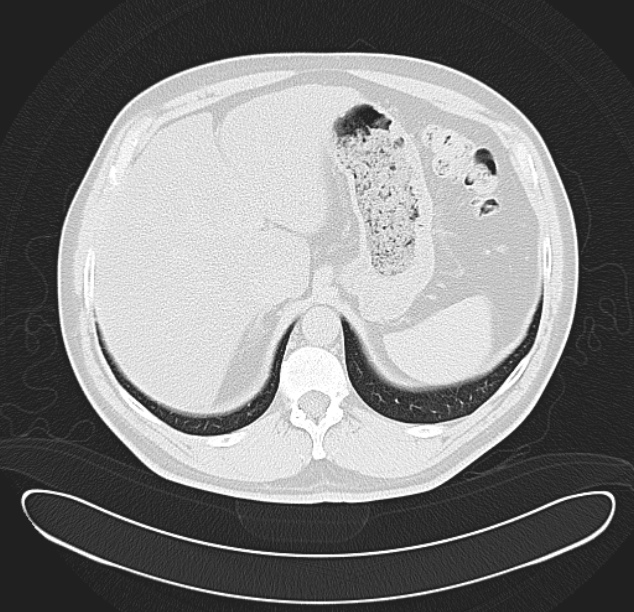 Centrilobular pulmonary emphysema (Radiopaedia 26808-26971 C 42).jpg