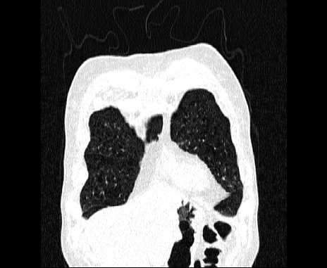 Centrilobular pulmonary emphysema (Radiopaedia 62468-70718 Coronal lung window 11).jpg