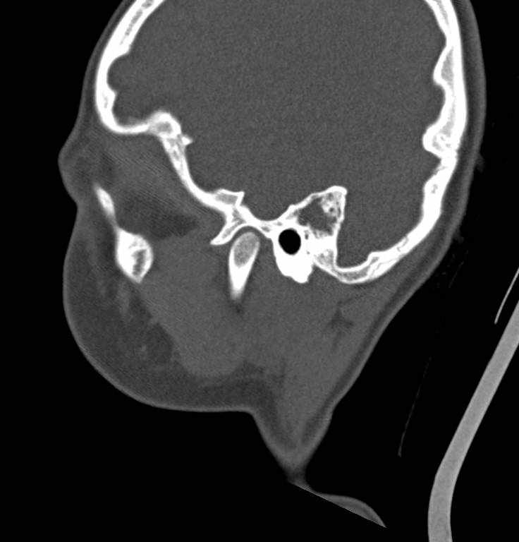 Cerebellar abscess (Radiopaedia 73727-84527 Sagittal bone window 29).jpg
