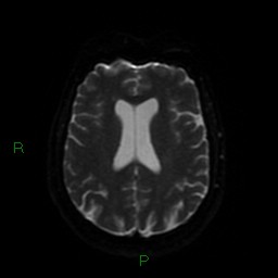 Cerebellar abscess (Radiopaedia 78135-90678 Axial DWI 49).jpg