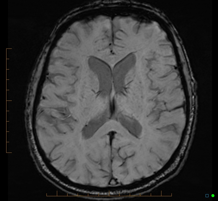 Cerebellar gangliocytoma (Radiopaedia 65377-74422 Axial SWI 33).jpg