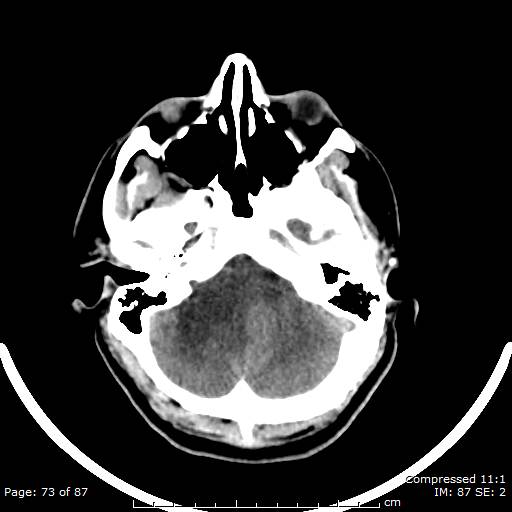 Cerebellar hemangioblastoma (Radiopaedia 52360-58258 Axial non-contrast 73).jpg