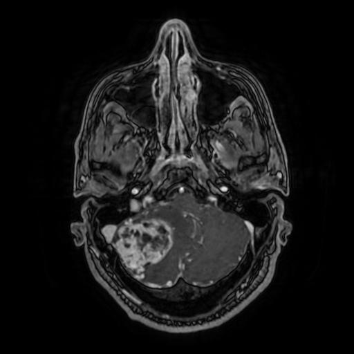 Cerebellar hemangioblastoma (Radiopaedia 88055-104622 Axial T1 C+ 47).jpg