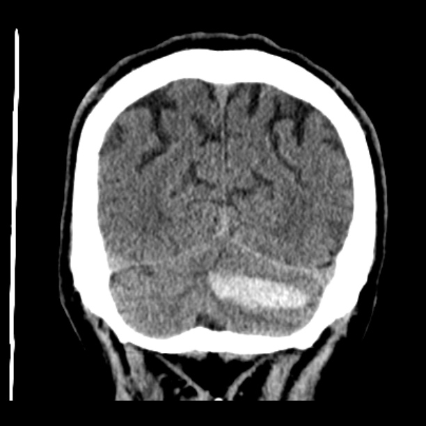 Cerebellar hemorrhage (Radiopaedia 27193-27359 Coronal non-contrast 47).jpg