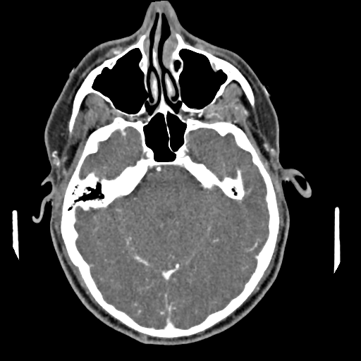 Cerebellar infarct due to vertebral artery dissection with posterior fossa decompression (Radiopaedia 82779-97029 C 5).png