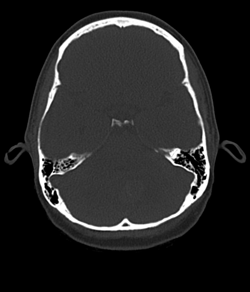 Cerebellar metastases - colorectal adenocarcinoma (Radiopaedia 40947-43652 AX Bone C- 2.0 MPR 18).png