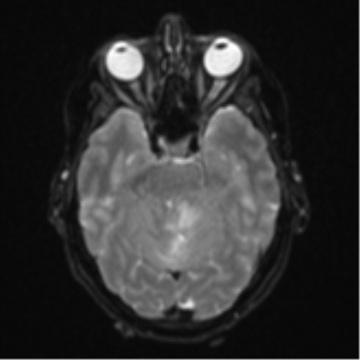 Cerebellar metastasis (Radiopaedia 51137-56765 Axial DWI 10).png