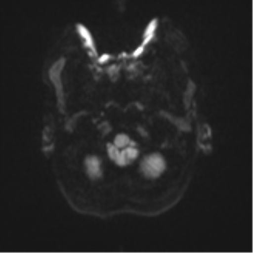 Cerebellar metastasis (Radiopaedia 51137-56765 Axial DWI 31).png