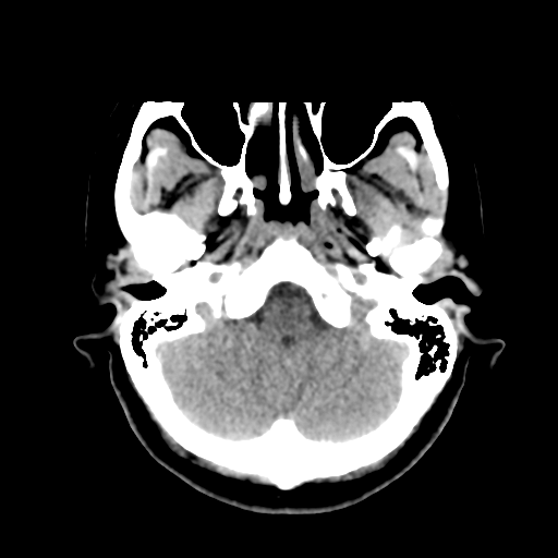 Cerebellar metastasis (cystic appearance) (Radiopaedia 41395-44258 Axial non-contrast 11).png