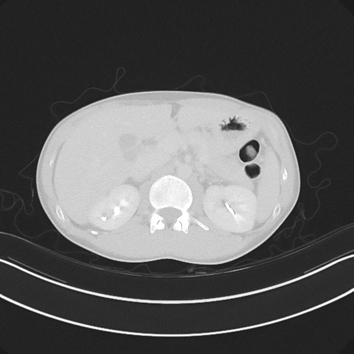 Cerebellar metastasis - adenocarcinoma lung (Radiopaedia 63184-71717 Axial lung window 73).png