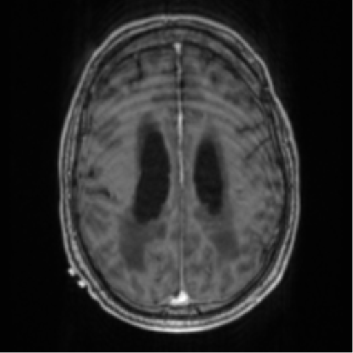 Cerebellar metastasis from lung adenocarcinoma (Radiopaedia 86690-102829 Axial T1 C+ 55).png