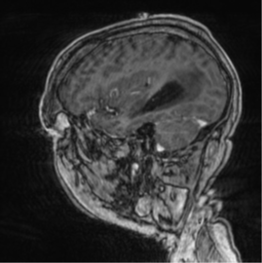 Cerebellar metastasis from lung adenocarcinoma (Radiopaedia 86690-102829 Sagittal T1 C+ 21).png