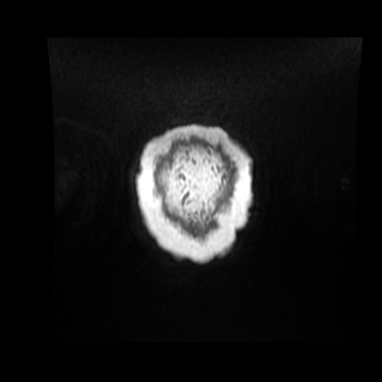 Cerebellar metastasis of pulmonary adenocarcinoma, cavernous venous malformation, and developmental venous anomaly (Radiopaedia 85827-101661 Coronal T1 C+ 7).jpg