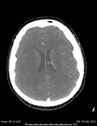 Cerebellar strokes due to intracranial giant cell arteritis (Radiopaedia 68799-78510 CT angiogram 35).jpg