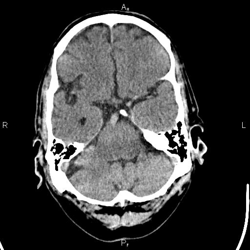 File:Cerebellopontine angle arachnoid cyst (Radiopaedia 85149-100704 Axial With contrast 12).jpg