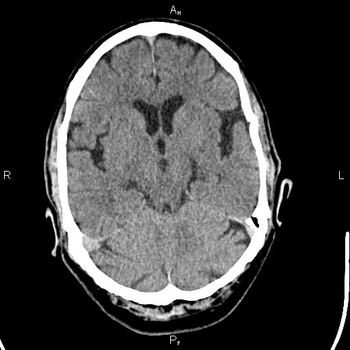 Cerebellopontine angle arachnoid cyst (Radiopaedia 85149-100704 Axial With contrast 19).jpg
