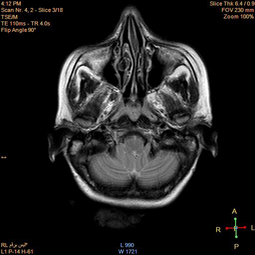 File:Cerebellopontine angle meningioma (Radiopaedia 22488-22525 Axial T2 1).jpg