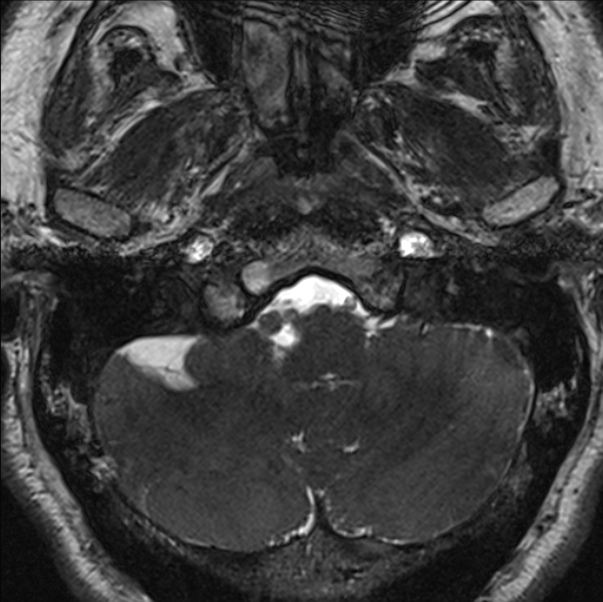 Cerebellopontine angle meningioma (Radiopaedia 24459-24764 I 11).jpg